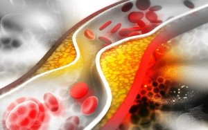 Illustration of cholesterol plaque in artery