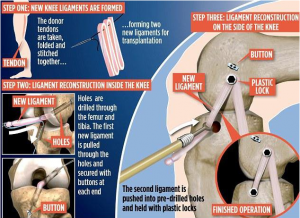 انقلابی در بازسازی مفاصل آسیب دیده با روش جراحی جدی1د