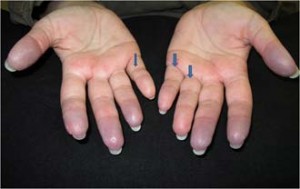 تغییر رنگ نوک بینی یا نوک انگشتان می‌تواند نشانه بیماری‌های روماتیسمی باشد