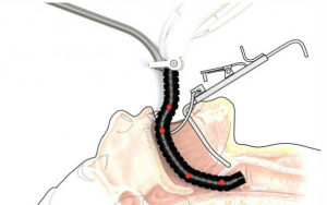 عمل جراحی بدون برش قلب با مار رباتیک